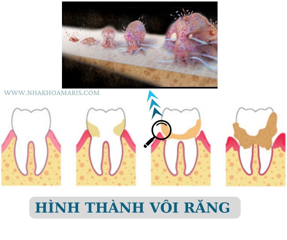 sự hình thành vôi răng