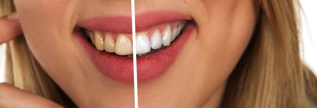 cạo vôi răng và tẩy trắng răng